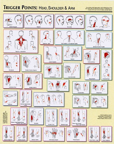 Trigger Points Chart (2) - Legge